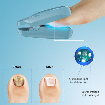 2023 New Arrivals🔥🔥- KTS® Antifungal Laser Device Without Any Side Effects Get Whitening Nail You Want To Show